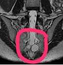 Tarlov Cyst and Pelvic Pain